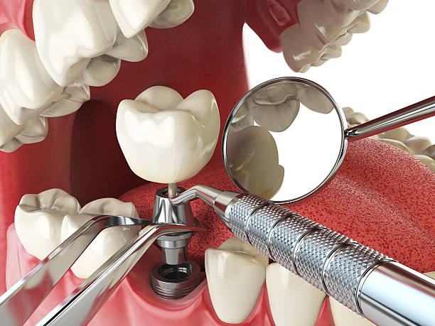 Best Emergency Root Canal Treatment in Minor, AL